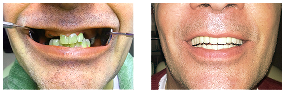 Implantálás - fogbeültetés előtt és után