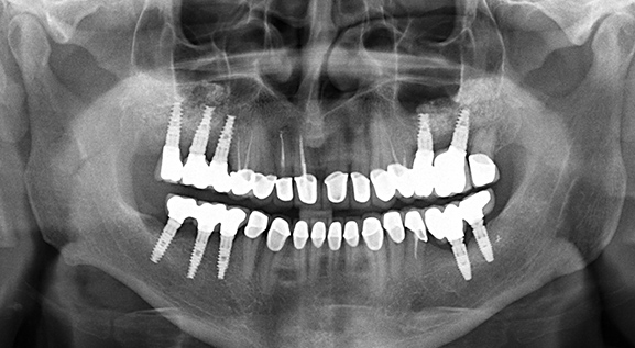 Fogimplantátum röntgen felvétel - fogászati kezelés után
