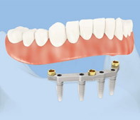 Stéges fogsor 4 implantátumon