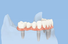 Teljes körhíd 6 implantátumon teljes fogsor pótlására