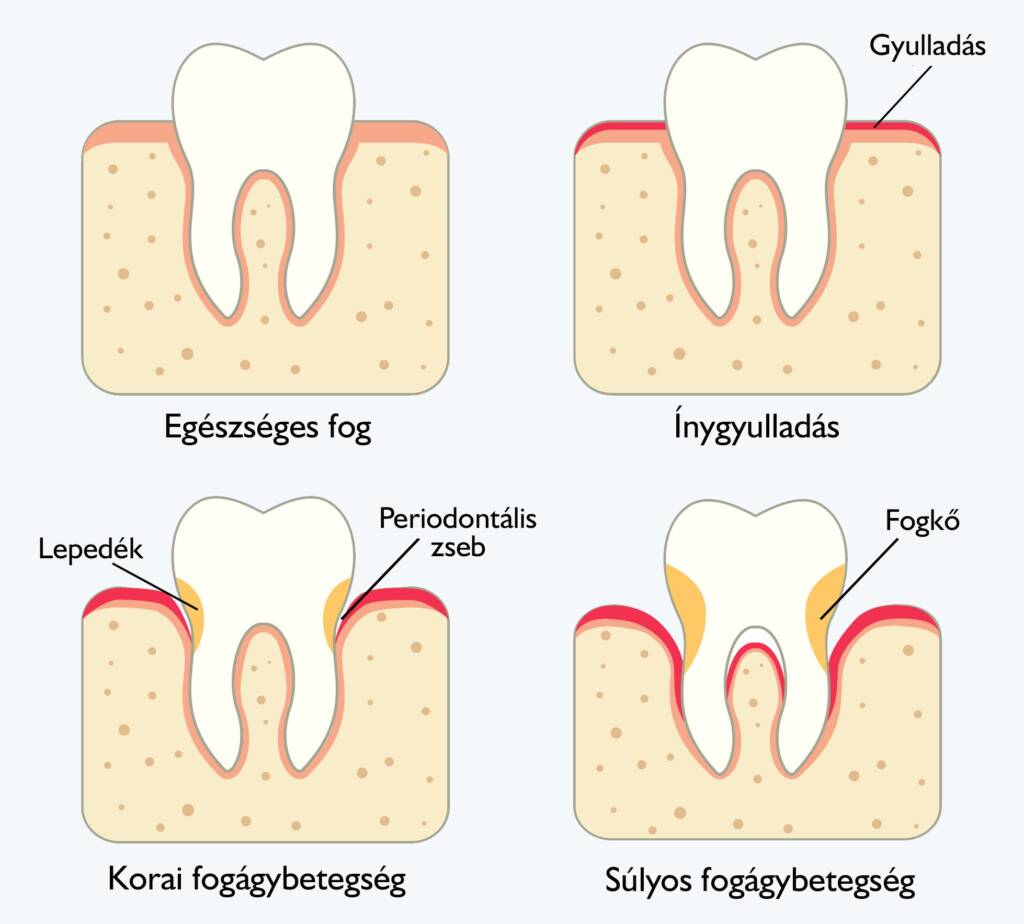 A fogágybetegség fázisai